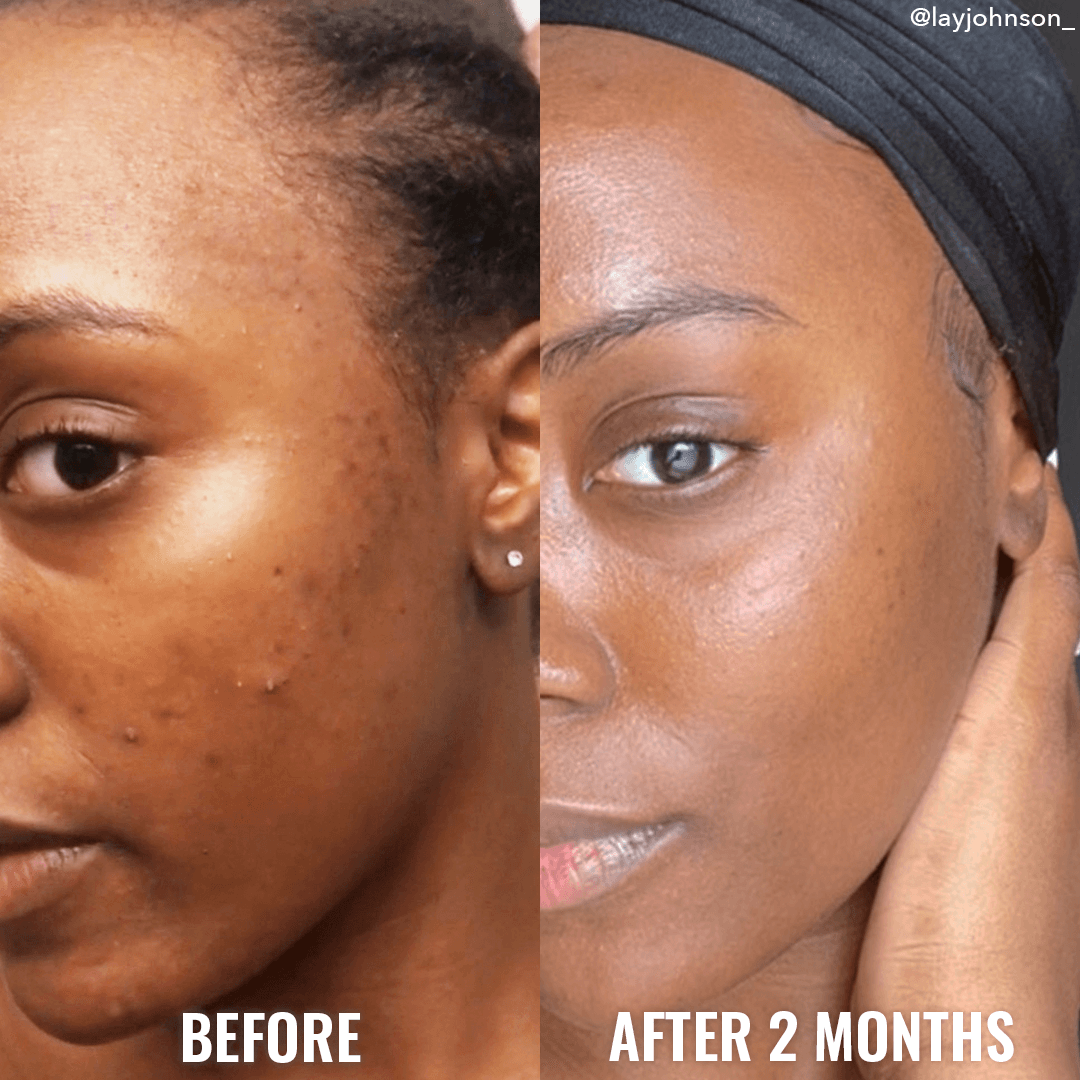 "Being a darker skinned person, I suffer from hyperpigmentation. Over the last 2 months, my skin has improved so much!"
